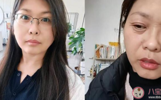 42岁女子20天断崖式衰老是怎么回事 为什么会出现断崖式衰老